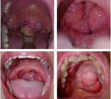 phát hiện ung thư vòm họng sớm nhờ nội soi tai mũi họng