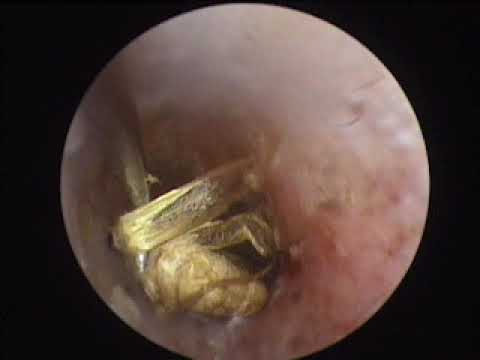 dị vật ở tai - hội chứng lớn về tai