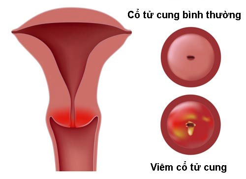 hình ảnh viêm cổ tử cung