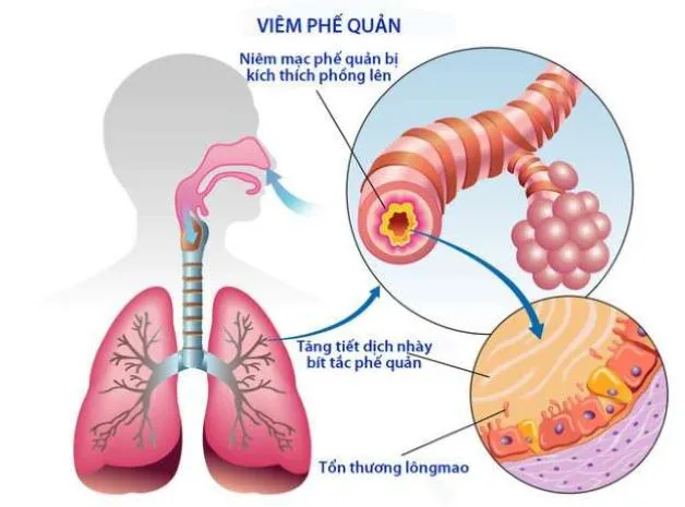 Viêm phế quản là một bệnh lý phế quản