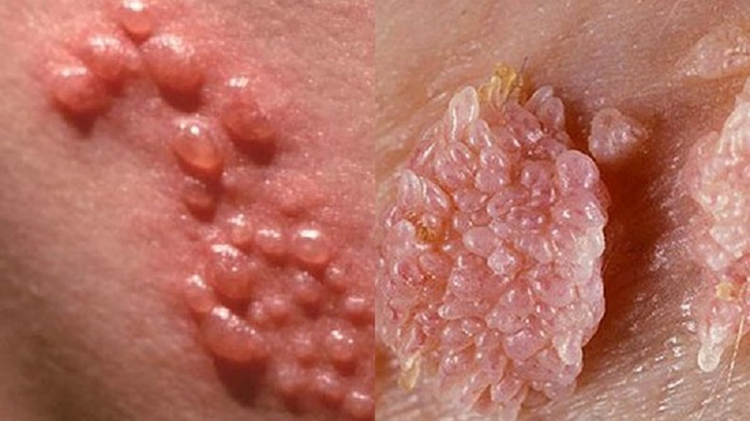 bệnh sùi mào gà