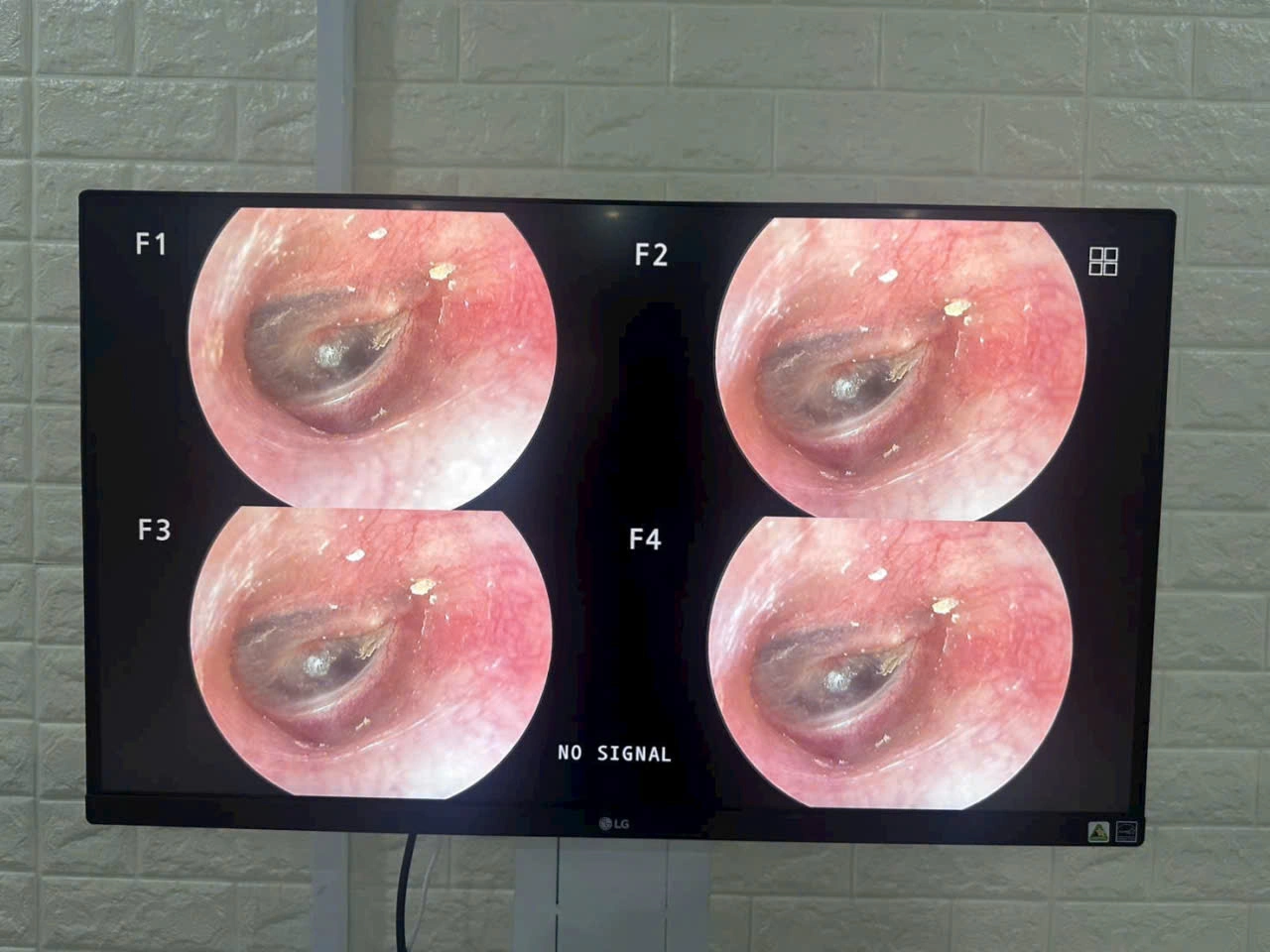 Máy nội soi tai mũi họng ống cứng hàn quốc
